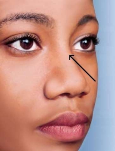 <strong>The part of the nose that falls just below the eyes and is indicated by the arrow in the picture is called the </strong> A) bridge. B) root. C) ala nasi. D) dorsum nasi.