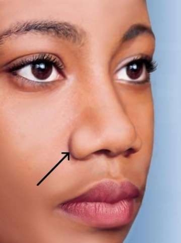 <strong>The outer edge of the nostril, indicated by the arrow in the picture below, is called the </strong> A) greater alar cartilage. B) anterior naris. C) alar nasal sulcus. D) nasal septum.