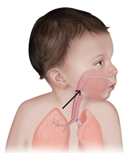 <strong>The arrow in the image below is pointing to which part of the throat? </strong> A) Epiglottis B) Trachea C) Vocal fold D) Palatine tonsil
