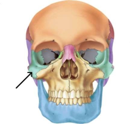 <strong>Which bone is highlighted in this picture? </strong> A) Temporal bone B) Mandible C) Maxilla D) Zygomatic bone