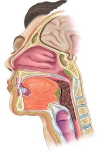<strong>What is depicted in this image? </strong> A) Swallowing B) Epiglottitis C) Tonsilitis D) Choking