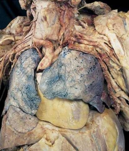 <strong>What is this view of the chest called? </strong> A) Anterior B) Posterior C) Sagittal D) Transverse