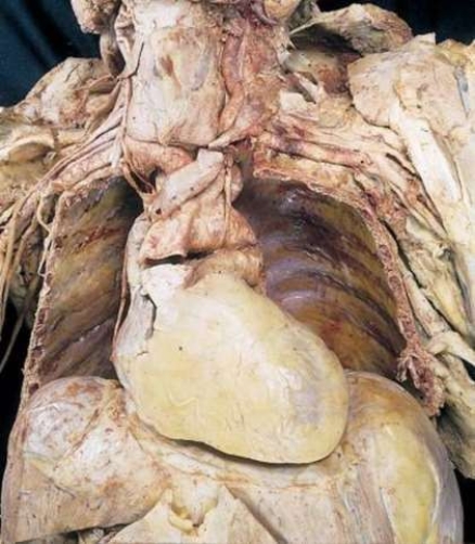 <strong>Which body structures are visible toward the center of this picture? </strong> A) Lungs, diaphragm, liver B) Spleen, rib cage, lungs C) Heart, spleen, liver D) Rib cage, heart, diaphragm