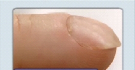 On assessment, the nurse notes the patient's fingernails appear as shown. What statement by the nurse is correct?   A)   I will document this as clubbed nails.  B)   The nail angle is   120 degrees.  C)   The client has a genetic disorder.  D)   The client has a fungal infection. 