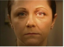 A nurse makes this finding when assessing a patient. What does the nurse understand about this assessment?   A)  This is a normal finding in postmenopausal women. B)  This is a normal finding for anyone. C)  This signifies an ophthalmologic emergency. D)  This indicates the ophthalmoscope is malfunctioning.