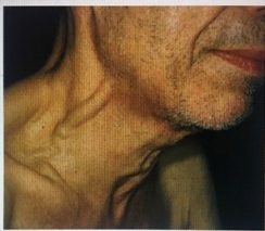 What does the nurse understand about this finding, seen in a hospitalized client?   A)  This is normal for an older client. B)  This demonstrates jugular venous distention. C)  This shows a carotid bruit. D)  This demonstrates a deviated trachea.