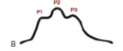 The nurse is caring for a client whose intracranial pressure waveform appears as shown. What action by the nurse is best?   A)  Calculate the client's CPP. B)  Ensure the client's neck is midline. C)  Document the findings in the chart. D)  Call an RRT.