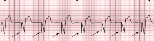 A nurse caring for a client who has a pacemaker sees the following rhythm on the cardiac monitor. What action by the nurse is best?   A)  Notify the provider immediately. B)  Prepare to defibrillate the client. C)  Document the findings in the chart. D)  Assess the client's perfusion.