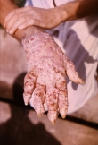 This is a picture of what NTD?   