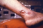 This is a picture of which NTD's lesion?   