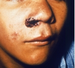This is a picture of which NTD's lesion?   