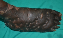 This is a picture of what NTD?   