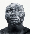 This picture shows a man suffering from what NTD?   