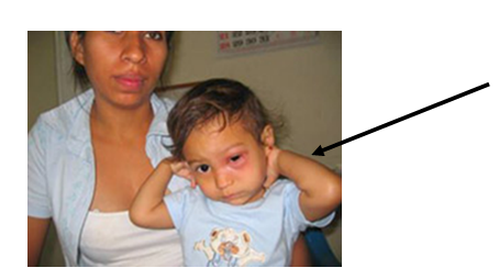 What is the swelling at the corner of this child's eye called?   