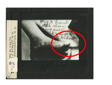 This photo illustrates what initial symptom of hookworm disease?   