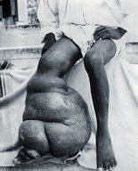 What is this condition commonly known as?   