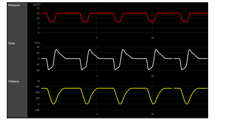 The scalars below are consistent with the presence of:   A)  gas trapping. B)  slow rise time. C)  flow asynchrony. D)  positive response to bronchodilator.
