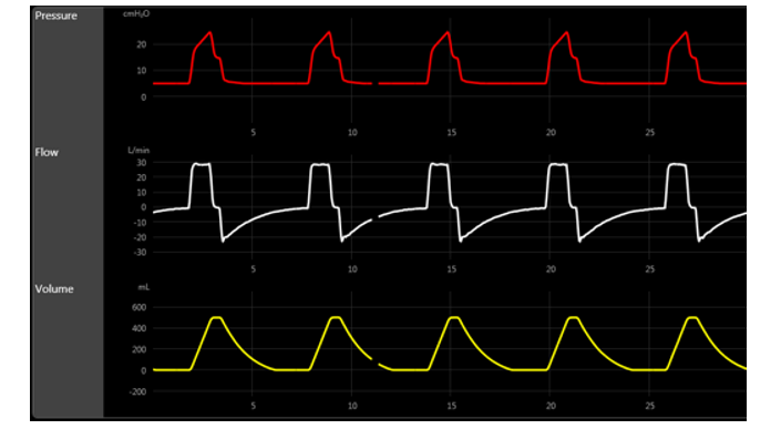 The P-T and the F-T (with brief inspiratory hold)  of a patient admitted for COPD exacerbation confirm the presence of:   A)  air leak. B)  cycling asynchrony. C)  air trapping. D)  increased airway resistance.