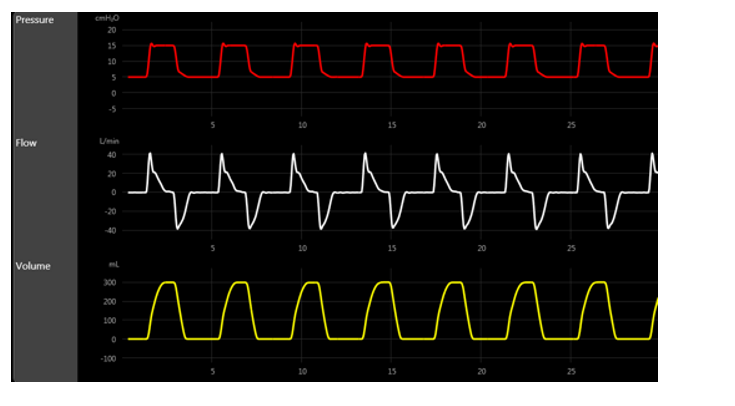 The P-T of a patient displays a bump at the beginning of the initial inspiratory tracing. This change is consistent with:   A)  increased airway resistance. B)  fast rise time. C)  decreased lung compliance. D)  air trapping.