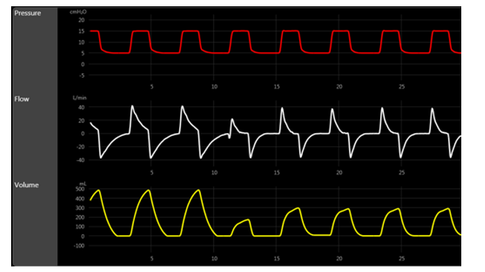 On the first round of the evening, a critical care fellow is asking the respiratory therapist what mode of ventilation these scalars are more consistent with. The RT should answer:   A)  VAC. B)  PAC. C)  PRVC. D)  APRV.