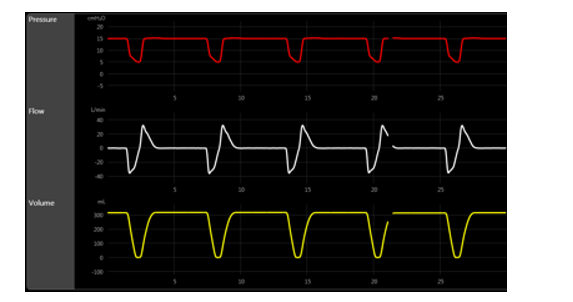 Which mode of ventilation is more consistent with the scalars below?   A)  SIMV B)  APRV C)  PS D)  PAC