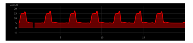 What type of PVA does this P-T waveform represent?   A)  Trigger asynchrony B)  Flow asynchrony C)  Delayed cycling D)  Premature cycling