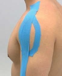 What pathology of the shoulder is being addressed in the figure?   A)  Acromioclavicular separation B)  Bicipital tendon impingement C)  Shoulder instability D)  Shoulder impingement E)  Deltoid strain