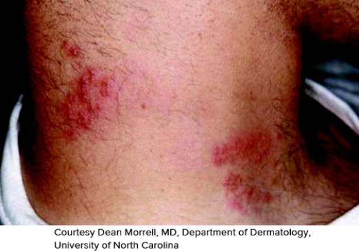A patient presents with the skin condition demonstrated in the figure. It seems to be following an area that is consistent with dermatome T6. What could be wrong with this patient?   A)  Herpes simplex labialis B)  Herpes simplex gladiatorum C)  Herpes zoster D)  Verruca virus E)  Molluscum contagiosum