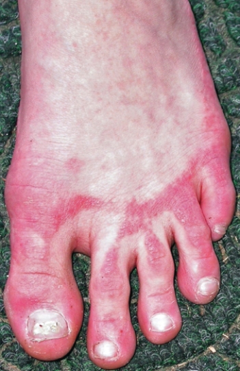 <strong>A freshman volleyball player presents with a skin condition demonstrated in the figure. What is wrong with this athlete?  </strong> A) Contact dermatitis B) Scabies C) Hives D) Measles E) Mumps <div style=padding-top: 35px> 
