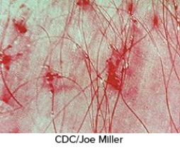 You notice that a patient is constantly scratching the head. Upon further investigation you see the sores demonstrated in this figure. What could be wrong with this patient? A) Scabies B) Pediculosis C) Tick bites D) Spider bite E) Pityriasis rosea