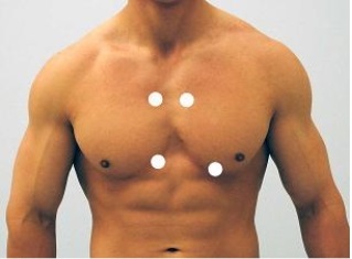 Which figure below correctly shows the four sites used for auscultation of heart sounds? A)    B)    C)    D)    E)   