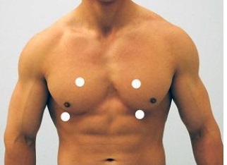 Which figure below correctly shows the four sites used for auscultation of heart sounds? A)    B)    C)    D)    E)   