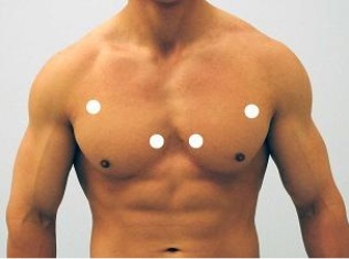 Which figure below correctly shows the four sites used for auscultation of heart sounds? A)    B)    C)    D)    E)   