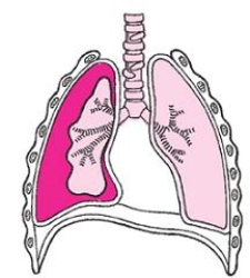 The figure demonstrates which of the following lung injuries?   A)  Pneumothorax B)  Tension pneumothorax C)  Hemothorax D)  Traumatic asphyxia E)  Hyperventilation