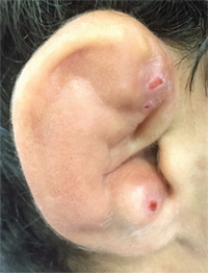 The problem demonstrated in this figure of the ear is commonly referred to as which of the following?   A)  Auricular hematoma B)  Otitis externa C)  Otitis media D)  Pinna E)  Impacted cerumen