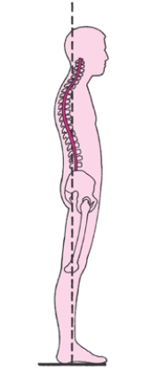 <strong>In the following image, what are the anatomical malalignments of the spine and other involved structures? </strong> A) Kyphotic position that causes compensatory position of the head and neck B) An abnormal curvature in one direction and a compensatory secondary curve in the opposite direction C) Increase in both the anterior tilt of the pelvis and in hip flexion D) Posterior shift of the thoracic segment and anterior shifting of the entire pelvis E) Increased thoracic curve and protracted scapulae producing a rounded shoulder appearance
