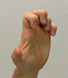 If a patient is suffering from the problem noted in the figure of the hand, which nerve would be damaged?   A)  The ulnar nerve B)  The radial nerve C)  The median nerve D)  The axillary nerve E)  The musculocutaneous nerve