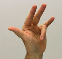 The figure of the wrist, hand, and fingers demonstrates which of the following conditions?   A)  Boutonniere deformity B)  Mallet finger C)  Dupuytren's contracture D)  Trigger finger E)  Gamekeepers thumb
