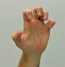 If a patient is suffering from the problem noted in the figure of the hand, which nerves would be damaged? A) Ulnar nerve and radial nerve B) Radial nerve and median nerve C) Median nerve and ulnar nerve D) Ulnar nerve and musculocutaneous nerve E) Musculocutaneous nerve and median nerve