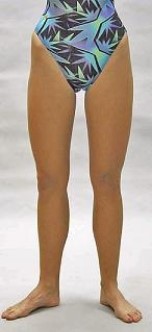 Based on this picture, what is most likely wrong with this person?   A)  Femoral retroversion B)  Femoral anteversion C)  Pathological sacroiliac joint dysfunction D)  Leg-length discrepancy E)  Tightness of the rectus femoris