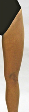 <strong>What is being measured in this illustration?  </strong> A) The girth of the femur. B) The length of the femur. C) The diameter of the patella. D) The A angle. E) The Q angle. <div style=padding-top: 35px> 