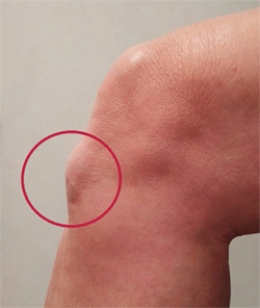 <strong>Based on this picture, what is the patient's condition?  </strong> A) Osgood Schlatter's disease B) Larsen-Johansson disease C) Jumper's knee D) Cyclist's knee E) Patellofemoral stress syndrome <div style=padding-top: 35px> 