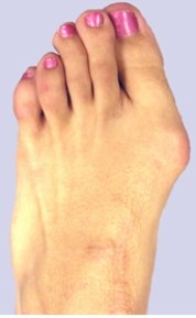 <strong>This figure demonstrates which of the following conditions?  </strong> A) Sesamoiditis B) Pes cavus C) Pes planus D) Metatarsalgia E) Hallux valgus deformity <div style=padding-top: 35px> 
