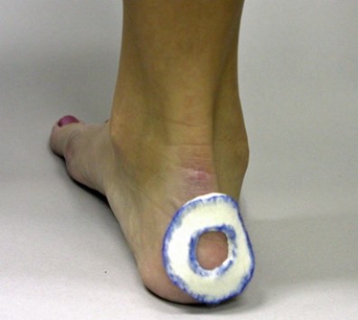 <strong>This type of pad (see below) can be used to treat all of the following problemsEXCEPT for which condition?  </strong> A) Heel contusion B) Retrocalcaneal bursitis C) Hallux valgus deformity D) A blister E) Morton's neuroma <div style=padding-top: 35px> 