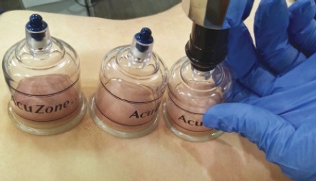 Please check all of the therapeutic reasons that this technique can be utilized.   A)  Improve blood flow B)  Increase edema C)  Reduce swelling D)  Elongate muscles E)  Reduce pain F)  Treat scar tissue in connective tissue G)  Reduce hematoma H)  Decrease nerve conduction velocity