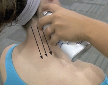 Which of the following statements is correct regarding this modality?   A)  The spray should be held at a 90 degree angle B)  The spray should only be 2-3 inches from the injured muscle C)  The spray should be perpendicular D)  The patient should do active stretching while the spray is being applied E)  The spray should cover the skin area 1-2 times