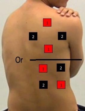 Identify the correct pad placement to administer interferential currents on the back. A)    B)    C)    D)    E)    