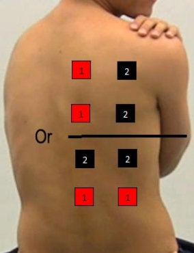 Identify the correct pad placement to administer interferential currents on the back. A)    B)    C)    D)    E)    