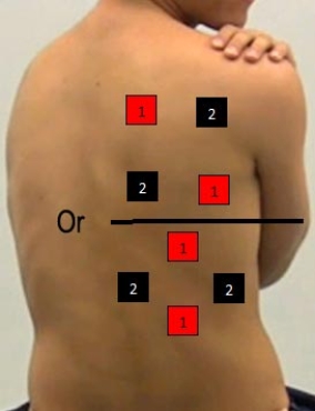 Identify the correct pad placement to administer interferential currents on the back. A)    B)    C)    D)    E)    