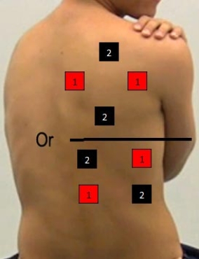 Identify the correct pad placement to administer interferential currents on the back. A)    B)    C)    D)    E)    